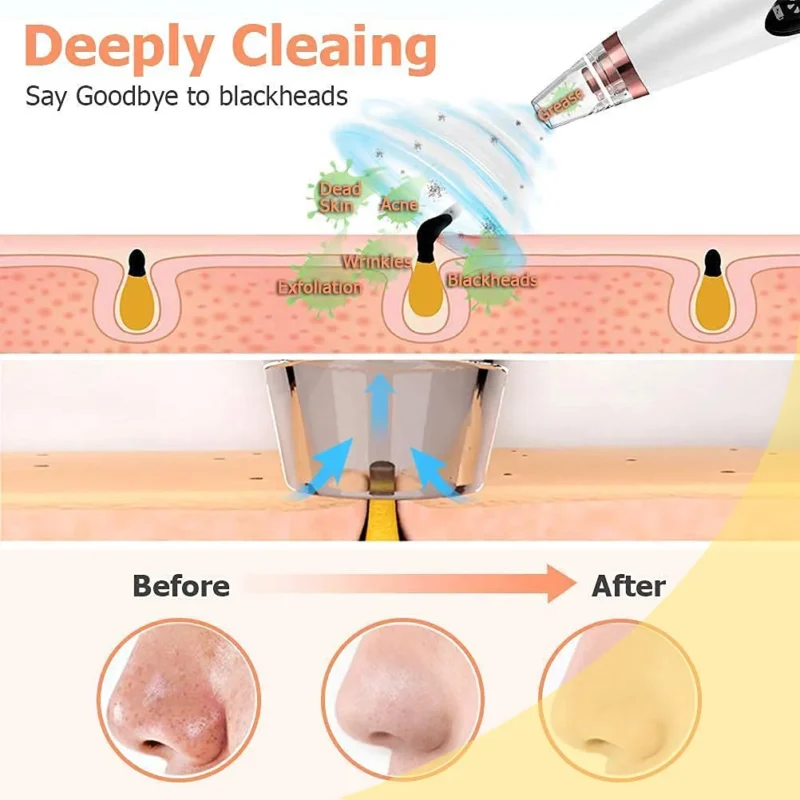 6 in 1 Multi-function Blackhead Remover Tools - Image 7