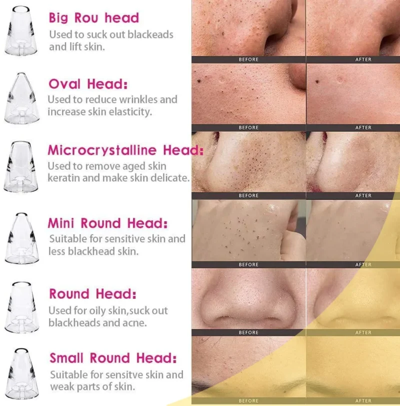 6 in 1 Multi-function Blackhead Remover Tools - Image 3